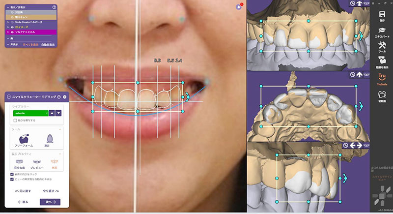 IOS & distal work